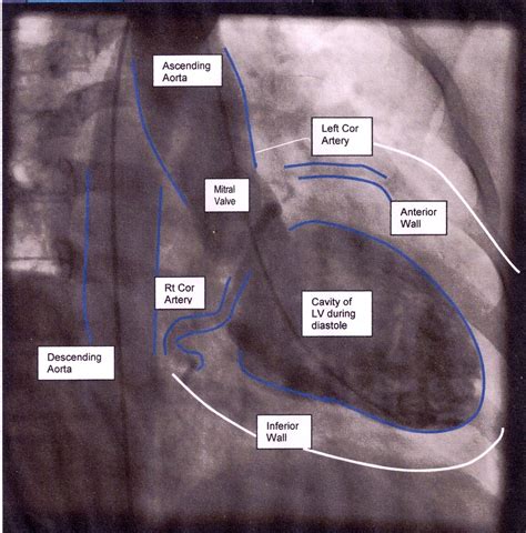 lv gram|left heart cath with ventriculogram.